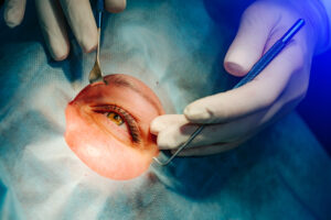 Paciente passando por cirurgia refrativa.