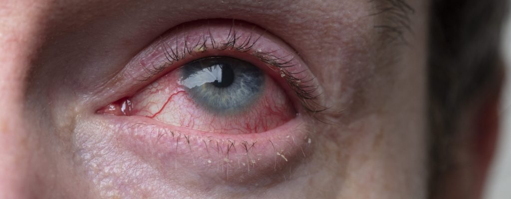 Imagem mostrando o olho de um homem com conjuntivite viral.