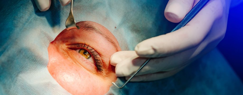 Paciente passando por cirurgia refrativa.