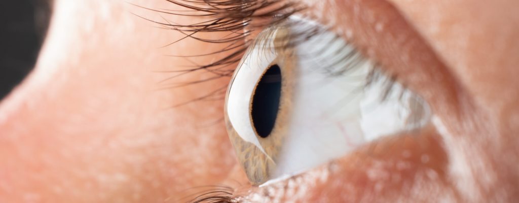 Olho com ceratocone. Imagem ilustrativa sobre o que é ceratocone.